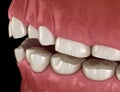 Dental attrition Bruxism resulting in loss of tooth tissue. Medically accurate tooth illustration