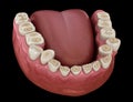 Dental attrition Bruxism resulting in loss of tooth tissue. Medically accurate tooth illustration