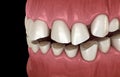 Dental attrition Bruxism resulting in loss of tooth tissue. Medically accurate tooth illustration