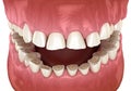 Dental attrition Bruxism resulting in loss of tooth tissue. Medically accurate tooth 3D illustration