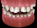Dental attrition Bruxism resulting in loss of tooth tissue. Medically accurate tooth 3D illustration