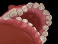 Dental attrition Bruxism resulting in loss of tooth tissue. Medically accurate tooth 3D illustration