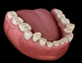 Dental attrition Bruxism resulting in loss of tooth tissue. Medically accurate tooth 3D illustration