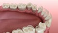 Dental attrition Bruxism resulting in loss of tooth tissue. Medically accurate tooth 3D animation