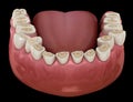 Dental attrition Bruxism resulting in loss of tooth tissue. Medically accurate tooth 3D illustration