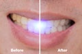 Before and After of dental bleaching in male whitening teeth for remove coffee or cigarette stains