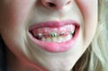 Dental brace Royalty Free Stock Photo