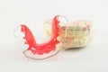 Dental brace and retainer Royalty Free Stock Photo