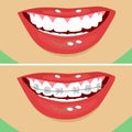 Dental braces, before and after