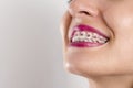 Dental braces