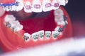 Dental brackets teeth straighteners Royalty Free Stock Photo