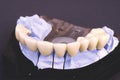 Dental bridge