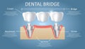 Dental bridge concept vector educational poster, diagram Royalty Free Stock Photo