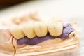 Dental bridge made of porcelain on casting Royalty Free Stock Photo