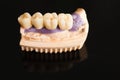 Dental bridge made of porcelain on casting Royalty Free Stock Photo