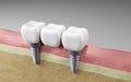 Dental bridge Dental teeth implants. Oral health and dental inspection teeth. Medical dentist tool, children healthcare, 3D render