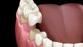 Dental bridge of 3 teeth over molar and premolar. Medically accurate 3D illustration
