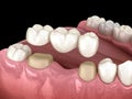 Dental bridge of 3 teeth over molar and premolar. Medically accurate 3D illustration of human teeth