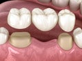 Dental bridge of 3 teeth over molar and premolar. Medically accurate 3D illustration of human teeth