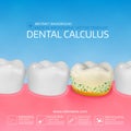 Dental calculus with bacteria. Colorful vector illustration.