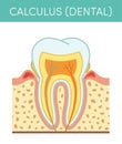 Dental calculus