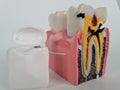 Dental care and tooth with caries. Teeth model with dental floss
