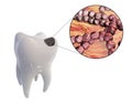 Dental caries and close-up view of microbes which cause caries