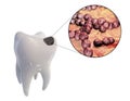 Dental caries and close-up view of microbes which cause caries