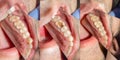 Dental caries. Filling with dental composite photopolymer material using rabbders. The concept of dental treatment in a dental Royalty Free Stock Photo