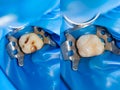 Dental caries. Filling with dental composite photopolymer material using rabbders. The concept of dental treatment in a dental