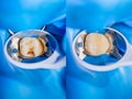 Dental caries. Filling with dental composite photopolymer material using rabbders. The concept of dental treatment in a dental