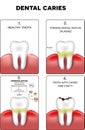 Dental caries formation