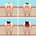 Dental caries stages.