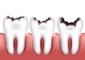 Dental caries