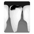 Dental caries. X-ray of tooth decay. Caries infographics. Vector illustration on isolated background. Royalty Free Stock Photo