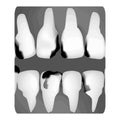 Dental caries. X-ray of tooth decay. Caries infographics. Vector illustration on isolated background. Royalty Free Stock Photo