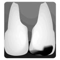 Dental caries. X-ray of tooth decay. Caries infographics. Vector illustration on isolated background. Royalty Free Stock Photo