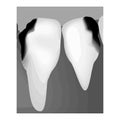 Dental caries. X-ray of tooth decay. Caries infographics. Vector illustration on isolated background. Royalty Free Stock Photo