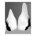 Dental caries. X-ray of tooth decay. Caries infographics. Vector illustration on isolated background. Royalty Free Stock Photo