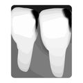 Dental caries. X-ray of tooth decay. Caries infographics. Vector illustration on isolated background. Royalty Free Stock Photo