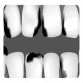 Dental caries. X-ray of tooth decay. Caries infographics. Vector illustration on isolated background. Royalty Free Stock Photo