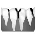 Dental caries. X-ray of tooth decay. Caries infographics. Vector illustration on isolated background. Royalty Free Stock Photo