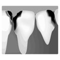 Dental caries. X-ray of tooth decay. Caries infographics. Vector illustration on isolated background. Royalty Free Stock Photo