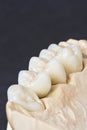 Dental ceramic bridge Royalty Free Stock Photo