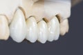 Dental ceramic bridge Royalty Free Stock Photo