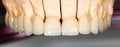 Dental ceramic bridge Royalty Free Stock Photo