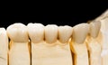 Dental ceramic bridge Royalty Free Stock Photo