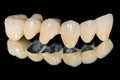 Dental ceramic bridge Royalty Free Stock Photo
