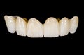 Dental ceramic bridge Royalty Free Stock Photo