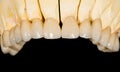 Dental ceramic bridge